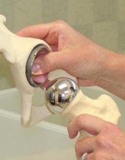 protezis_Szombathely csipoprotezis egészség online hirek